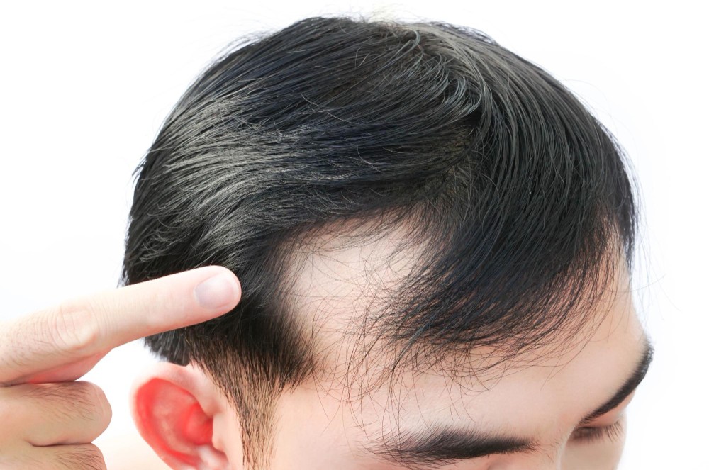 คลินิกผม ความเครียด